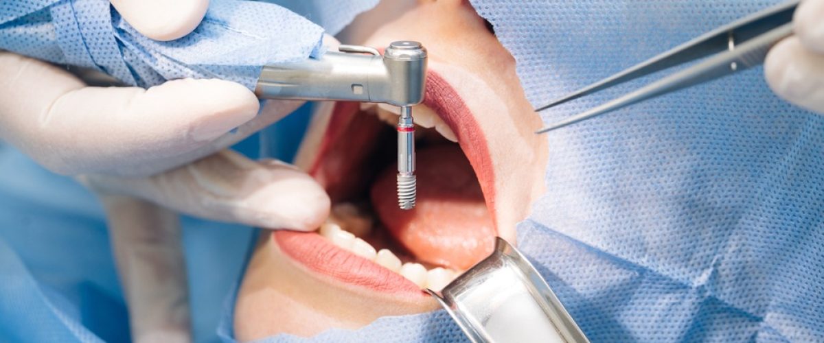 İmplant Tedavisi Hizmet Resim