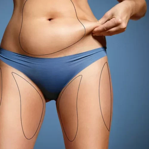 istanbul-liposuction-1170x620